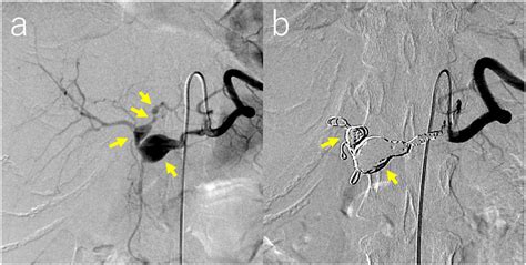 Angiography showing therapeutic procedures. (a) A celiac artery... | Download Scientific Diagram