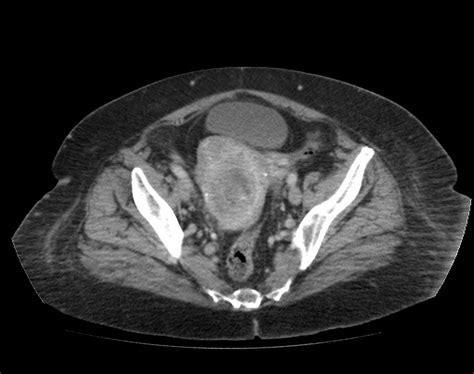 Radiopaedia case Hematometra and hematosalpinx as complications of ...