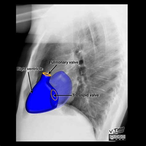 Cardiomediastinal anatomy on chest radiograph | Radiology Case | Radiopaedia.org | Radiographer ...