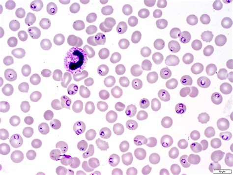 Pathology Outlines - Plasmodium falciparum