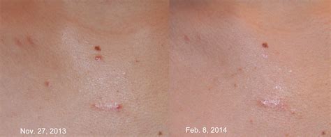 Keloid Treatment - Keloid Removal Expert - New York