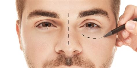 Achieving symmetry in eye shape after previous eyelid surgery - Arte Facial