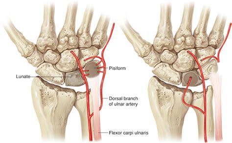 Lunate Resection and Vascularized Pisiform Transfer in Kienböck Disease | Musculoskeletal Key