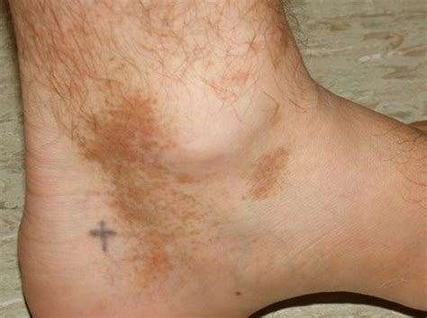 red splotches on lower legs - pictures, photos