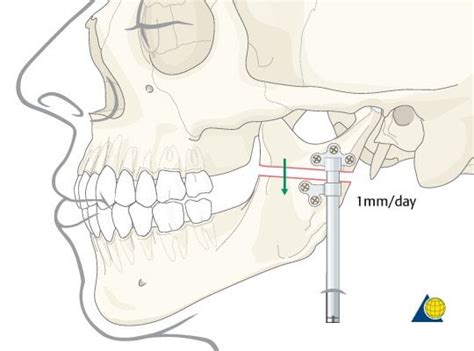 The overlooked importance of the ramus and chewing : r/orthotropics