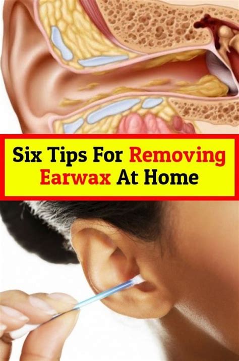 Here are six tips to remove Earwax in 2020 | Ear wax, Natural lubricant, Ear wax removal