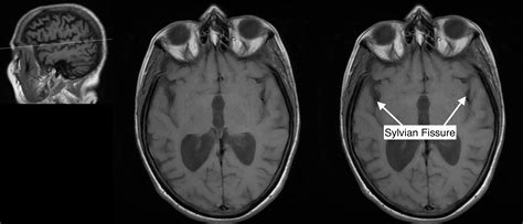 Radiological Anatomy: Sylvian Fissure - Stepwards