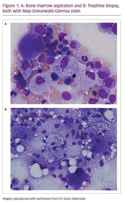 Finding and Treating Gaucher Disease Type 1 – The Role of the Haematologist | touchONCOLOGY