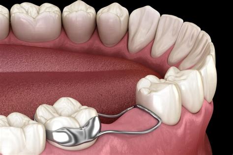 Exploring Space Maintainer Types In Dentistry - Next Dental Lab