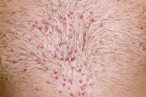 Folliculitis after chest waxing - Stock Image - C021/3287 - Science ...