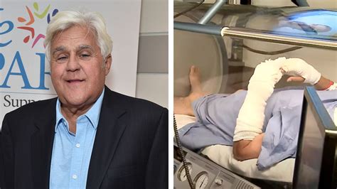 Jay Leno receives hyperbaric chamber treatment after he suffered ‘serious burns’ in gasoline ...