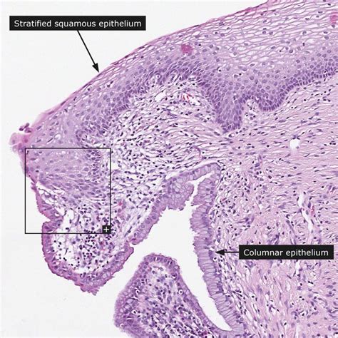 normal transformation zone histology cervix - Google Search | Histology ...