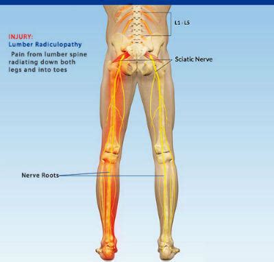 Lumbar Radiculopathy - Consult about the Disorder in India