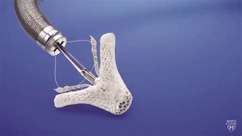 Mayo Clinic Minute: Mitral Valve Clip - YouTube