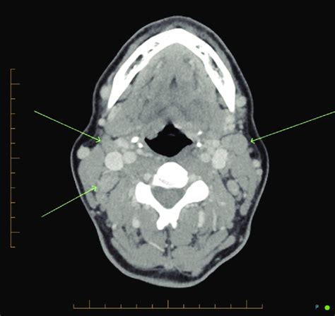 A Transverse Ct Section Of The Neck Demonstrates Enlarged Lymph Nodes | My XXX Hot Girl