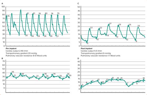 Pulmonary Artery and Pulmonary Capillary Wedge Pressure Traces from a... | Download Scientific ...