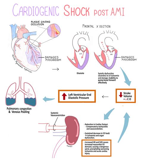 Cardiogenic Shock - Homecare24