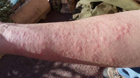 What Does it Mean if You Have These Rashes? | TipHero