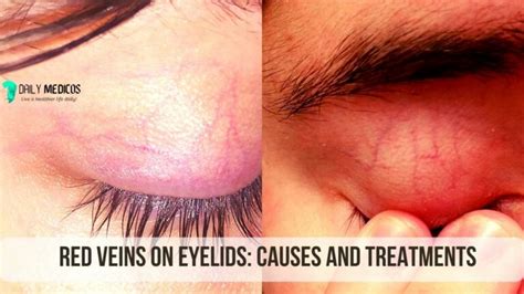 Red Veins on Eyelids: Causes and Treatments - Daily Medicos