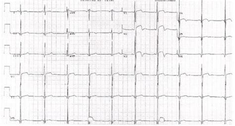 Wellen's Syndrome | Emergency Medicine Education | Resus