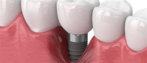 Dental Implant Failure: Causes, Symptoms, and Treatment Options