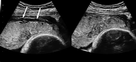 Placenta accreta spectrum: pathophysiology and evidence-based anatomy for prenatal ultrasound ...