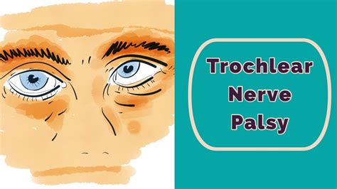 Trochlear Nerve Palsy Eye Position