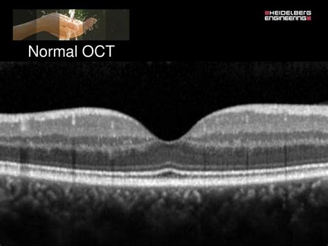 Spectralis oct normal anatomy & systematic interpretation.