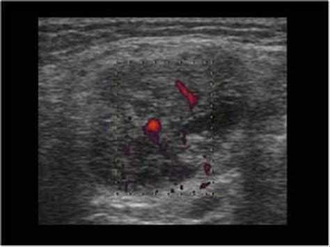 Head and Neck | 4.3 Salivary glands : Case 4.3.4 Warthin's tumors | Ultrasound Cases