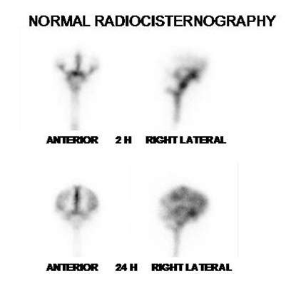 Normal Images Radiocisternography