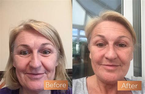 Absolute Collagen Before and After Pictures | Incredible Results ...