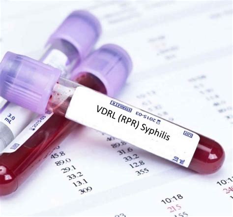 RPR test, RPR test for syphilis, RPR test results interpretation