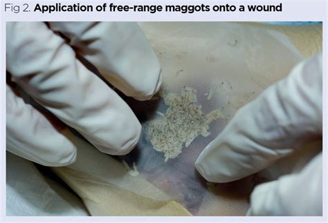 The principles of maggot therapy and its role in contemporary wound ...