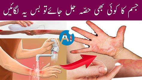 How to Treat a Burn Blister | Home Remedies for Burns | Urdu/Hindi ...