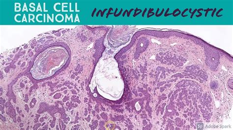 Superficial Basal Cell Carcinoma Histology