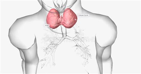 A Goiter is a Swollen, Rounded Lump in the Throat Caused by the Abnormal Enlargement of the ...