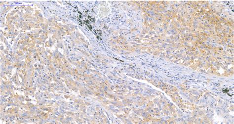 PD-1 and PD-L1 expression in rare lung tumors | Semantic Scholar