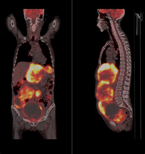 Stomach Tumor Gist