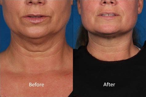 Breakthrough Treatments for Neck Wrinkles, Sagging and Double Chins at ...