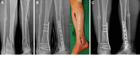 Distal Tibia Fibula Fracture Kopolkiwi | The Best Porn Website