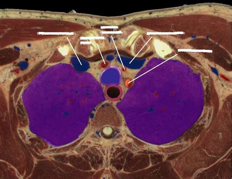 cadaver dissection 5 Diagram | Quizlet