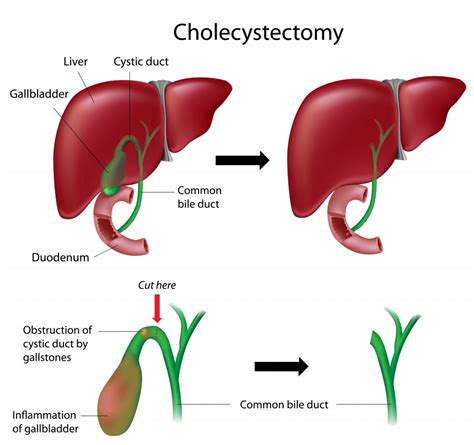 Cholecystectomy & SPL – GBMC Jordan