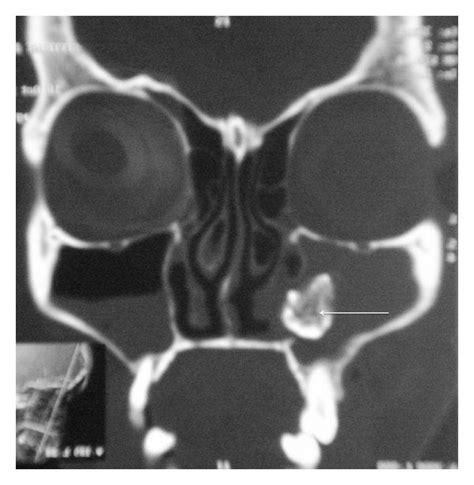 Maxillary Antrolith: A Rare Cause of the Recurrent Sinusitis