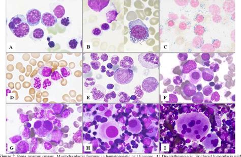 Figure 2 from Importance of Classical Morphology in the Diagnosis of Myelodysplastic Syndrome ...