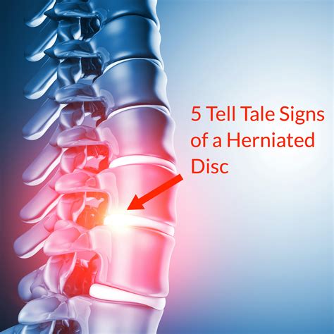 5 Tell Tale Signs of a Herniated Disc (Slipped Disc) - Fornham Chiropractic Clinic