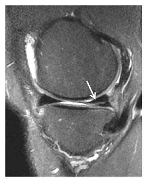 Oblique tears are a type of radial tear: (a) Coronal T2 FSE Fat Sat... | Download Scientific Diagram