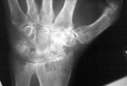 Wrist Arthritis - Hand - Orthobullets