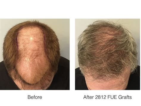 FUE Hair Transplant in Norwood 6 Patient | Hair Transplant Los Angeles ...