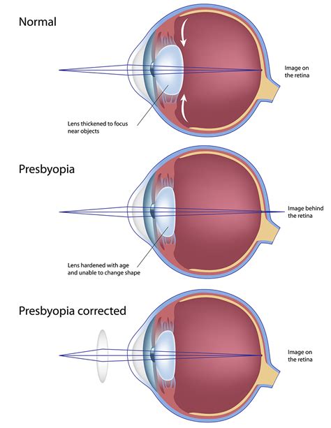 Eye Conditions