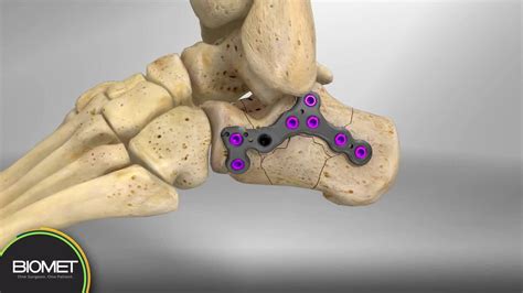 Calcaneus Stress Fracture Mri | lupon.gov.ph